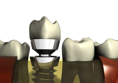 Zahnimplantate / Implantate